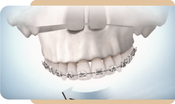 imagem 3d de boca com aparelho dentário