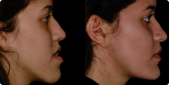 imagem antes e depois de cirurgia bucomaxilofacial