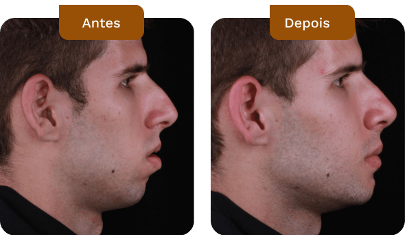 antes e depois de pacientes do dr rogério zambonato dentista na asa sul em brasília