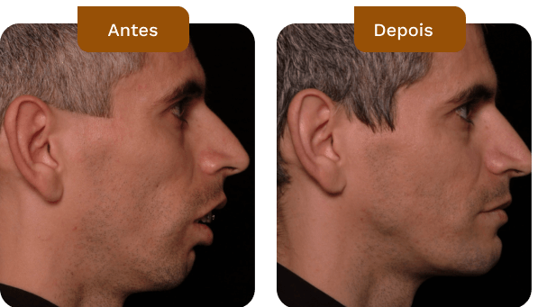 ortognática classe 2 antes e depois do dr rogério zambonato cirurgião bucomaxilofacial