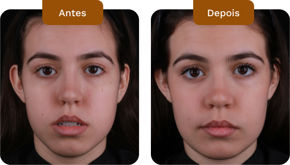 antes e depois de pacientes do dr rogério zambonato dentista na asa sul em brasília