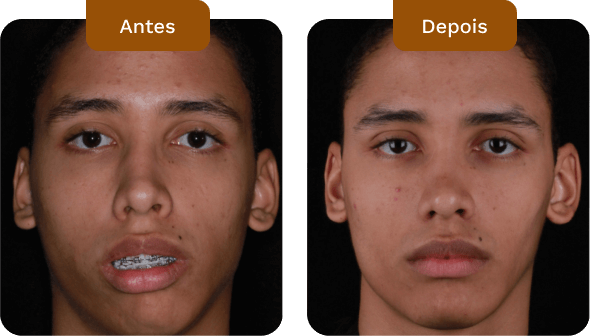 antes e depois de pacientes do dr rogério zambonato cirurgião bucomaxilofacial