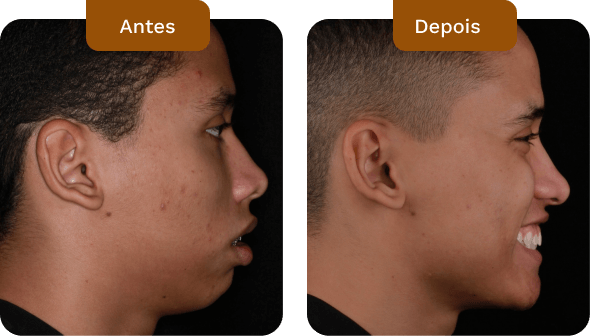 antes e depois de pacientes do dr rogério zambonato especialista em cirurgia ortognática