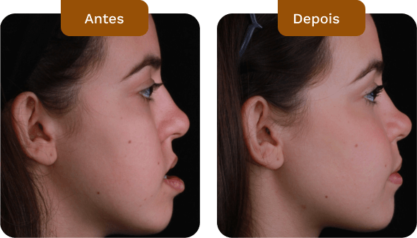 antes e depois de pacientes do dr rogério zambonato especialista em cirurgia ortognática
